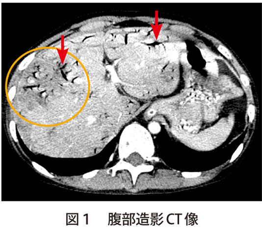 図1　腹部造影CT像