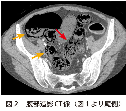 図2　腹部造影CT像（図1より尾側）