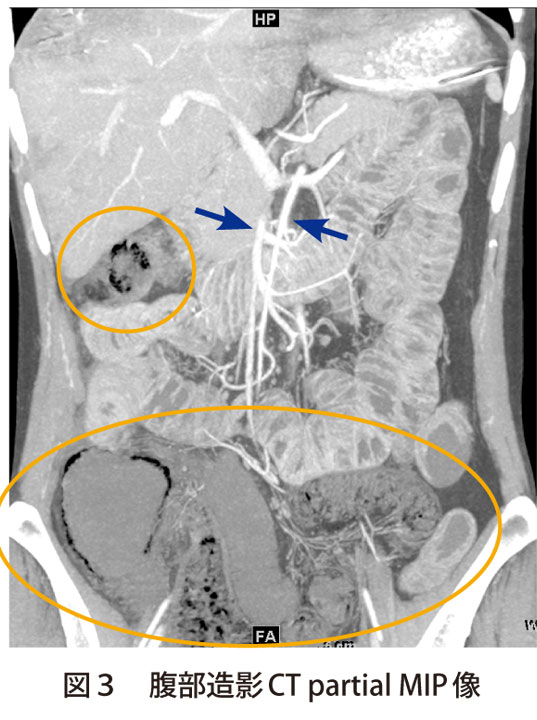 図3　腹部造影CT partial MIP像