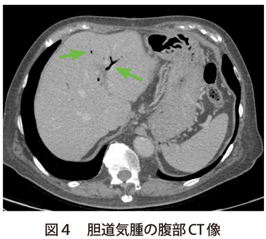 図4　胆道気腫の腹部CT像