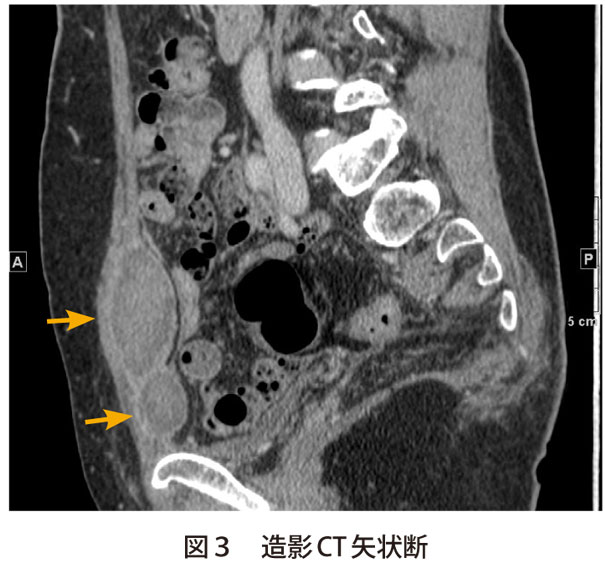 解答 解説 右下腹部痛 何を考えますか 実践 画像診断q A 羊土社 レジデントノート 実践 画像診断q A 羊土社 レジデントノート 羊土社