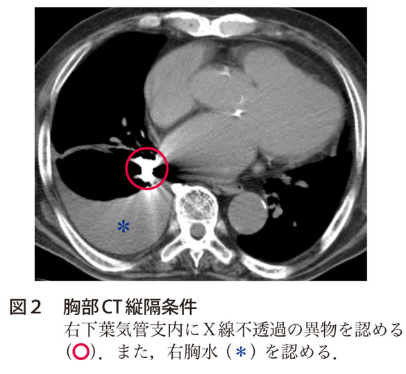 図2　胸部CT縦隔条件