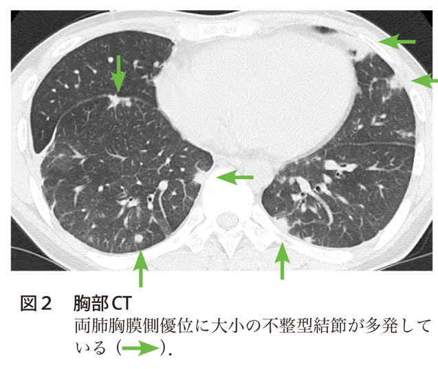 図2　胸部CT