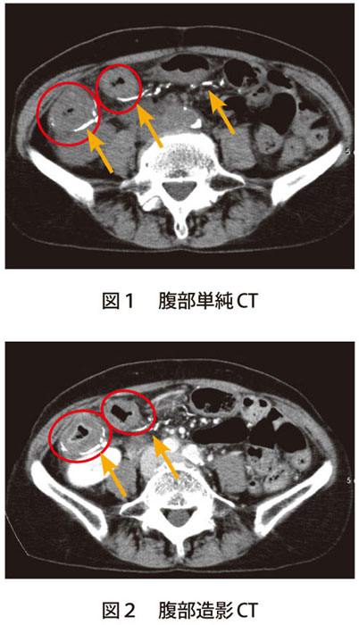 図1　腹部単純CT,図２　腹部造影CT