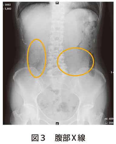 図3　腹部X線