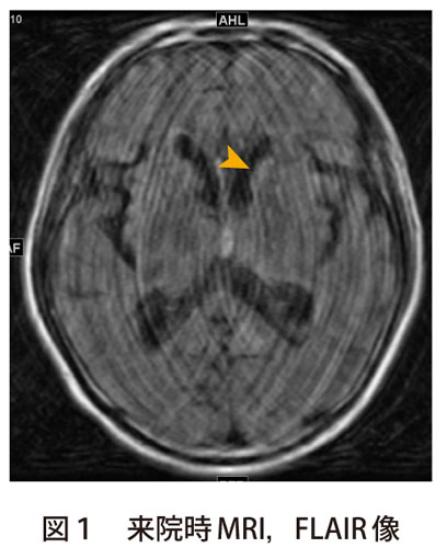 図1　来院時MRI，FLAIR 像