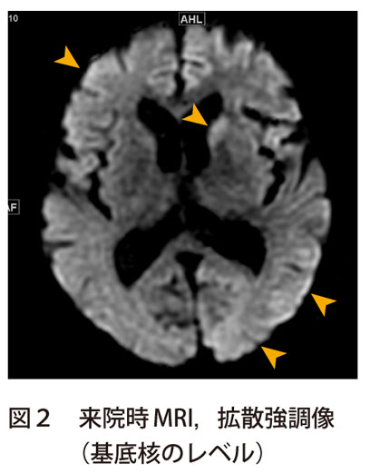 図2　来院時MRI，拡散強調像（基底核のレベル）