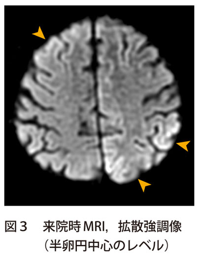 図3　来院時MRI，拡散強調像（半卵円中心のレベル）