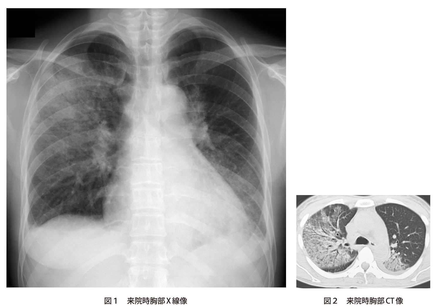 問題 発熱と全身倦怠感を訴える40歳代女性 実践 画像診断q A 羊土社 レジデントノート 実践 画像診断q A 羊土社 レジデントノート 羊土社