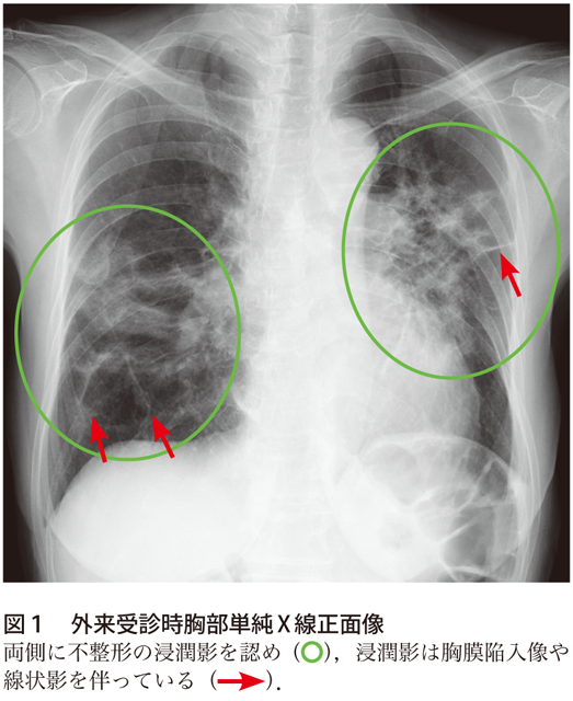 図１　外来受診時胸部単純X線正面像