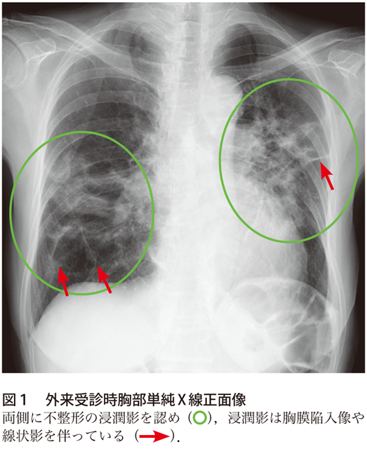 解答 解説 息切れを自覚する70歳代女性 実践 画像診断q A 羊土社 レジデントノート 実践 画像診断q A 羊土社 レジデントノート 羊土社