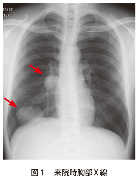 図1　来院時胸部X 線