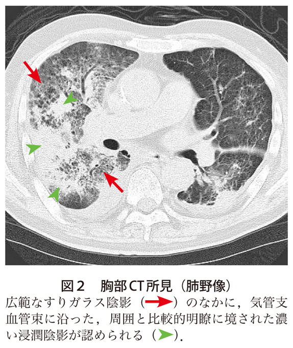 図2　胸部CT所見（肺野像）
