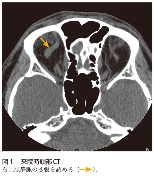 解答 解説 頭部外傷後 骨折や出血以外の所見も注目しよう 実践 画像診断q A 羊土社 レジデントノート 羊土社