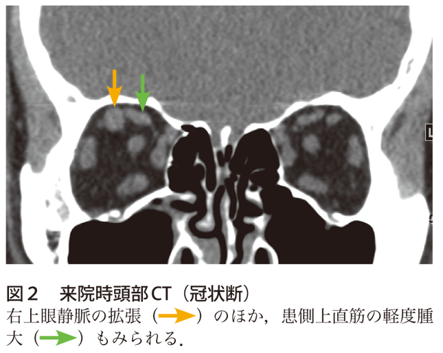 解答 解説 頭部外傷後 骨折や出血以外の所見も注目しよう 実践 画像診断q A 羊土社 レジデントノート 羊土社