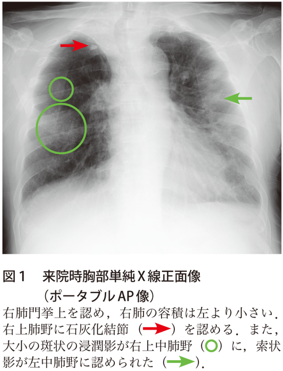 図1　来院時胸部単純X線正面像（ポータブルAP像）
