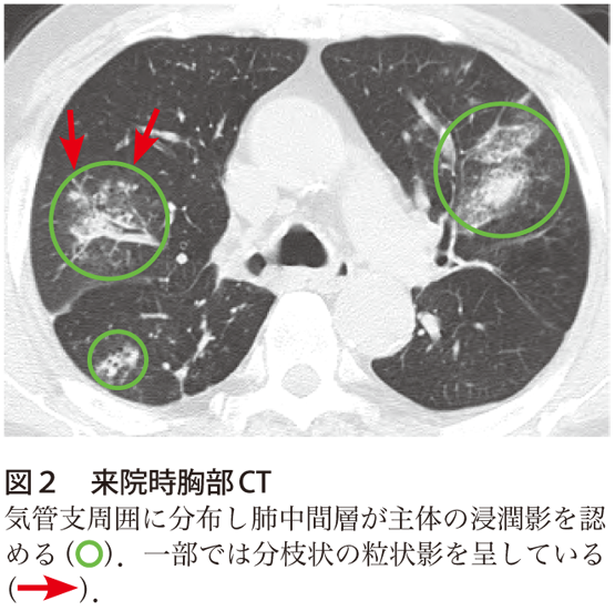 図2　来院時胸部CT