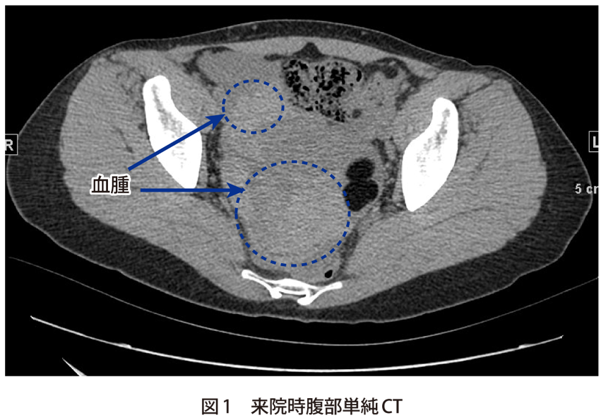 図1　来院時腹部単純CT