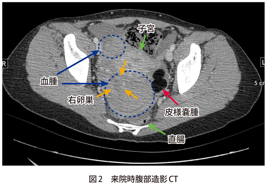 図2　来院時腹部造影CT