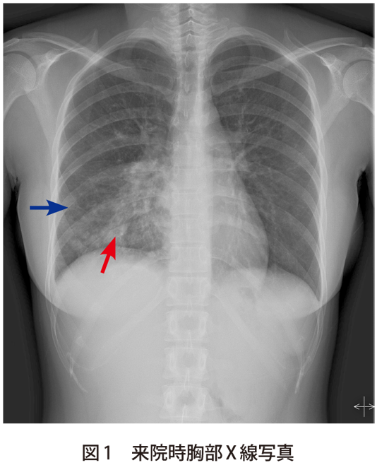 図1　来院時胸部X線写真