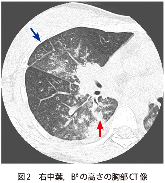 図2　右中葉，B6の高さの胸部CT像