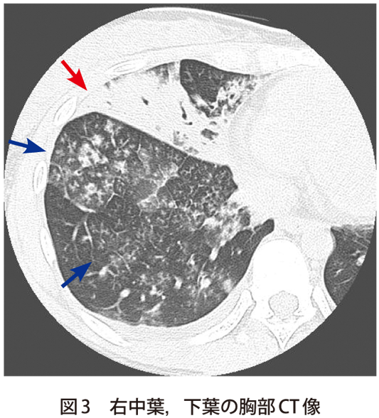 図3　右中葉，下葉の胸部CT像
