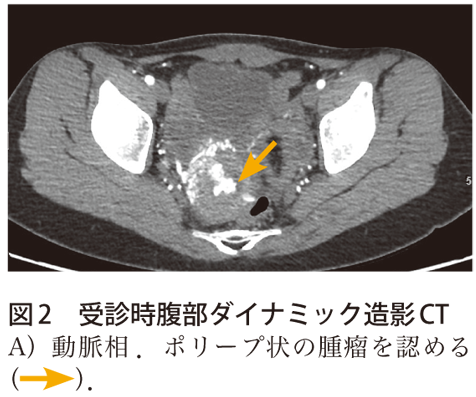 図2　受診時腹部ダイナミック造影CT