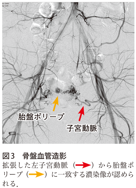 図3　骨盤血管造影
