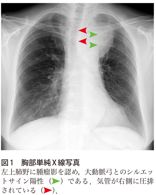 図1　胸部単純X線写真