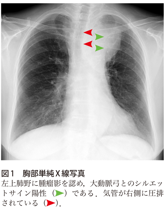 血胸診断 – ブラ サイズ 測ってもらう – HLZTF
