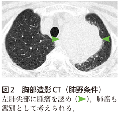 図2　胸部造影CT（肺野条件）