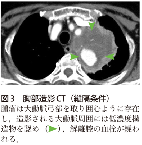 図3　胸部造影CT（縦隔条件）