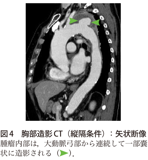 図4　胸部造影CT（縦隔条件）：矢状断像
