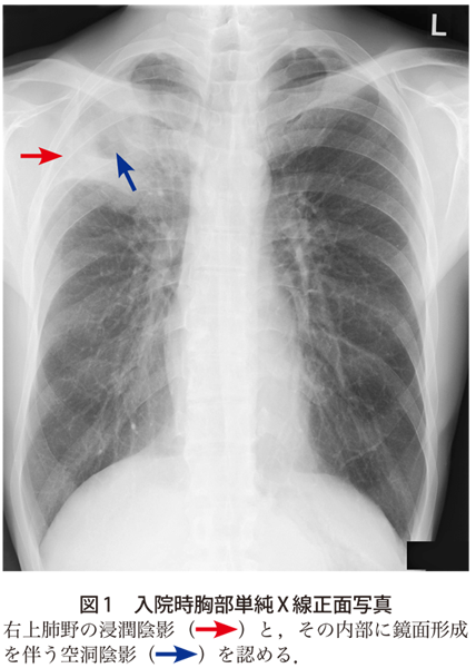図1　入院時胸部単純X線正面写真