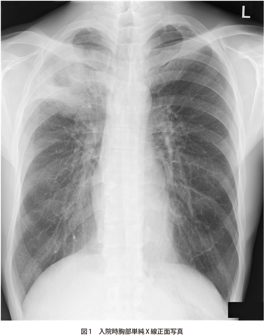 問題 感冒症状後に湿性咳嗽 発熱をきたした40歳代男性 実践 画像診断q A 羊土社 レジデントノート 実践 画像診断q A 羊土社 レジデントノート 羊土社