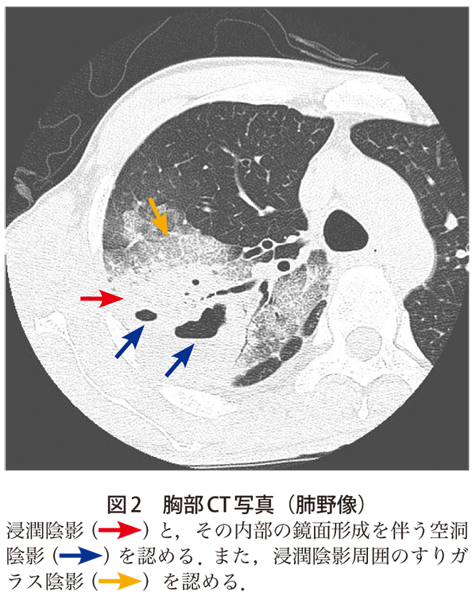 図2　胸部CT写真（肺野像）