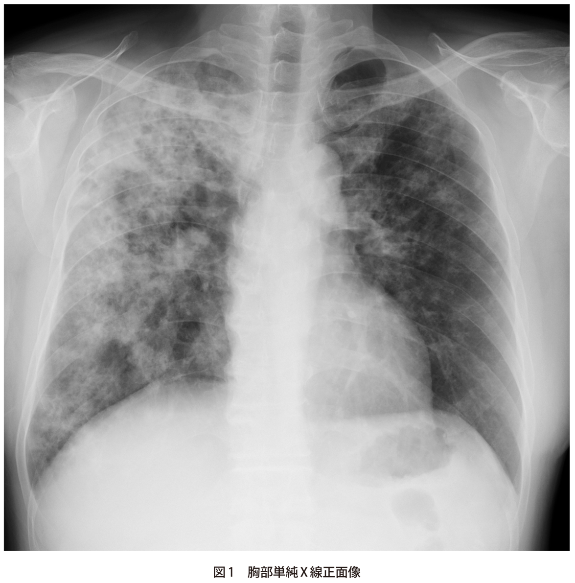 問題 咳と労作時呼吸困難の増悪で来院した40歳代男性 実践 画像診断q A 羊土社 レジデントノート 実践 画像診断q A 羊土社 レジデントノート 羊土社