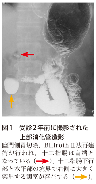 図1　受診2年前に撮影された上部消化管造影