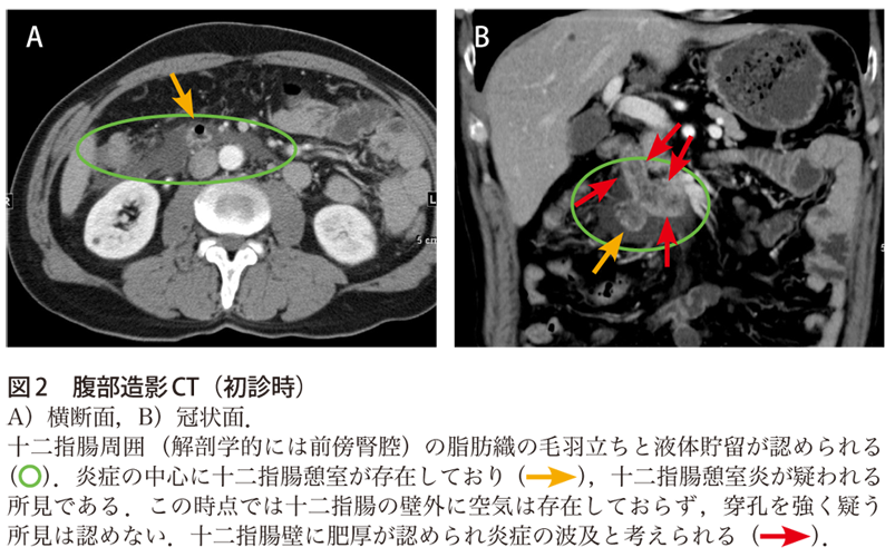 図2　腹部造影CT（初診時）