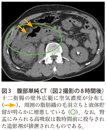 解答・解説】突然の腹痛．覚えておきたい疾患です．｜実践！画像診断Q&A｜羊土社：レジデントノート ｜実践！画像診断Q&A｜羊土社：レジデントノート -  羊土社
