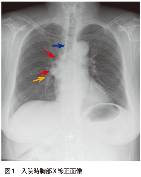 図1　入院時胸部X 線正面像