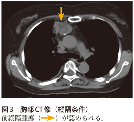 図3　胸部CT 像（縦隔条件）