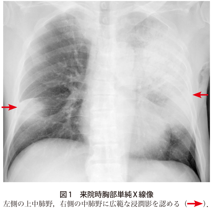 図1　来院時胸部単純X線像