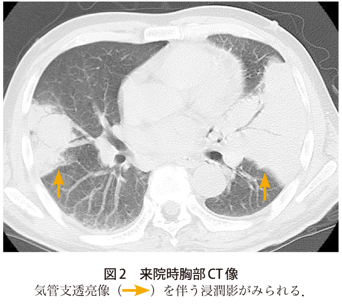 図2　来院時胸部CT像