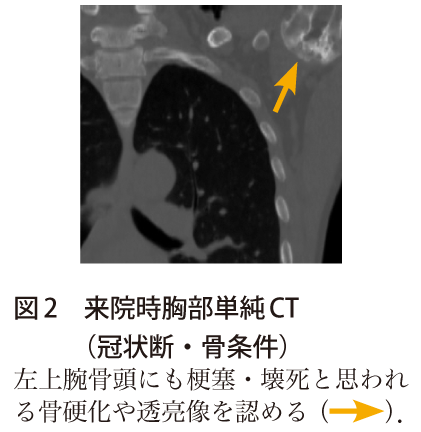 図2　来院時胸部単純CT