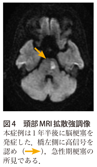 図4　頭部MRI 拡散強調像