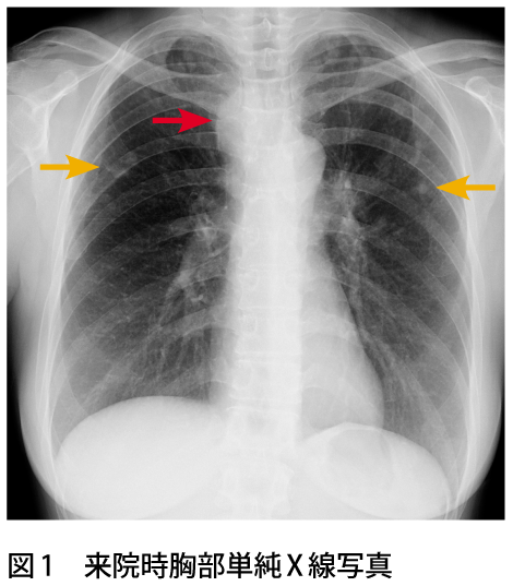図1　来院時胸部単純X 線写真