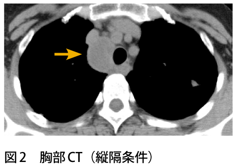 図2　胸部CT（縦隔条件）
