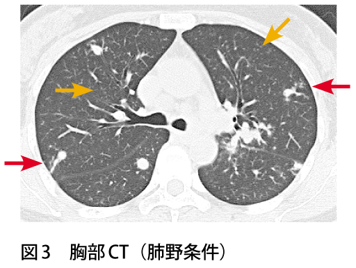 図3　胸部CT（肺野条件）