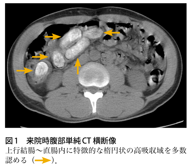 図1　来院時腹部単純CT 横断像